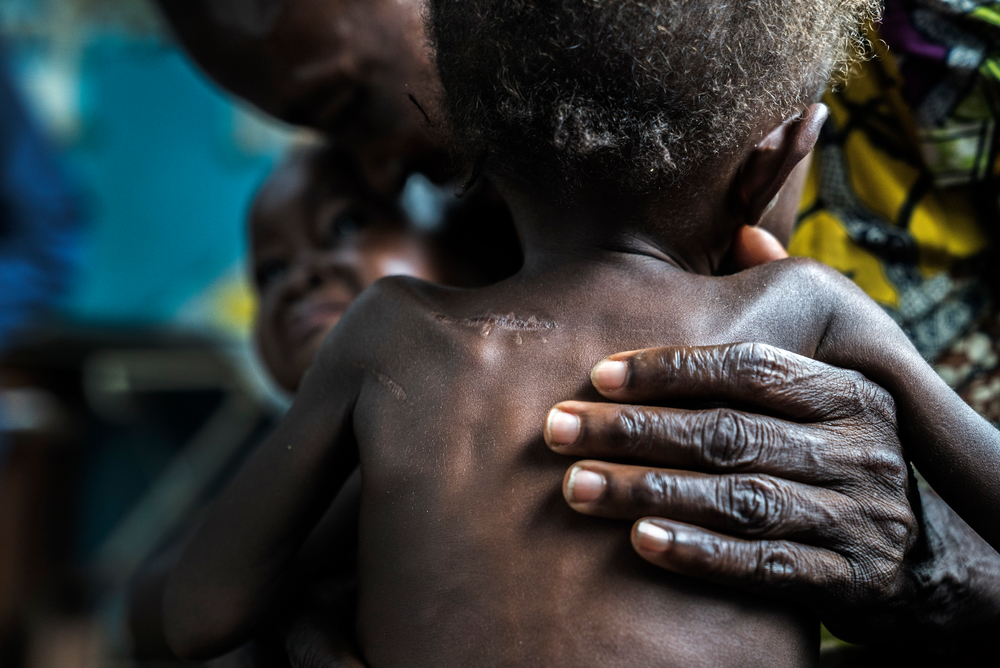 Λαϊκή Δημοκρατία Κονγκό: Τα υποσιτισμένα δίδυμα ηλικίας 17 μηνών έφτασαν στο κέντρο υγείας της Ντιτεκεμένα με τους παππούδες τους. Κρύβονταν στο δάσος επί πέντε μήνες, όταν ένοπλοι επιτέθηκαν στα χωριά. Οι γονείς τους σκοτώθηκαν και τα μωρά έχουν εμφανή στο σώμα τους τραύματα από μαχαίρι. (Σεπτέμβριος 2017)